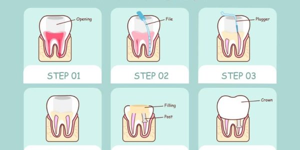 are root canals bad for your health